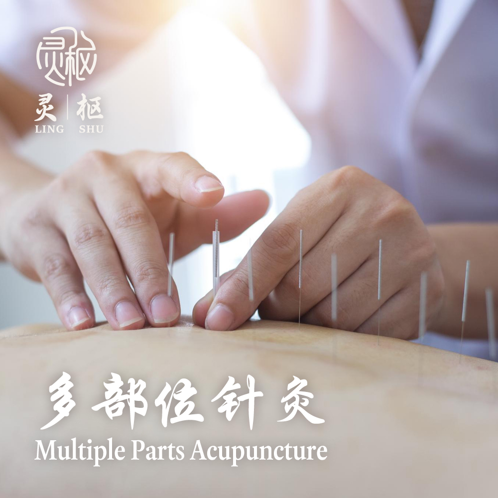 Multiple Part Acupunture 1000x